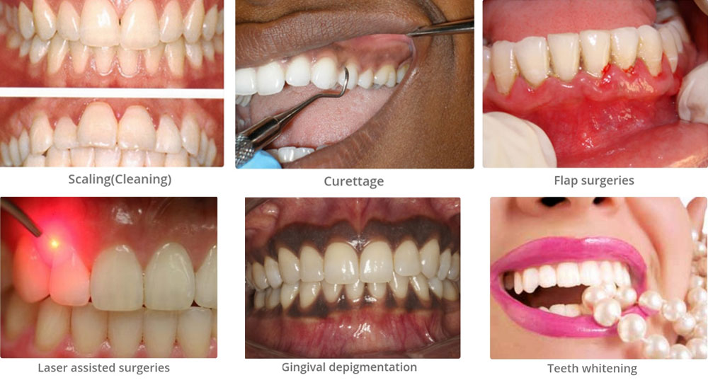 calculus teeth